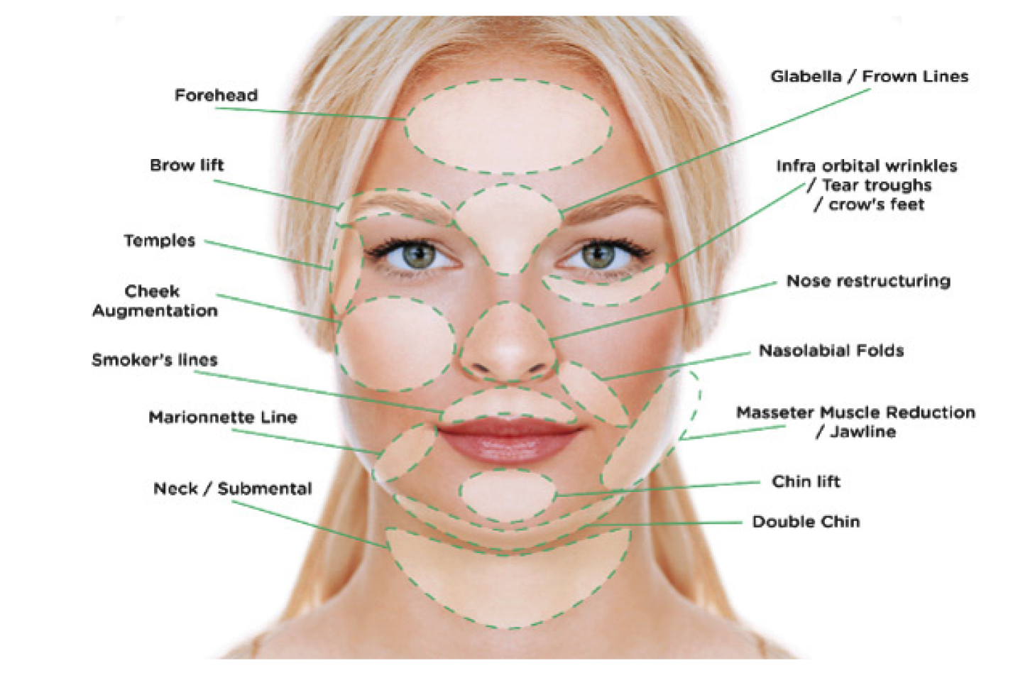 pdo thread lift complications